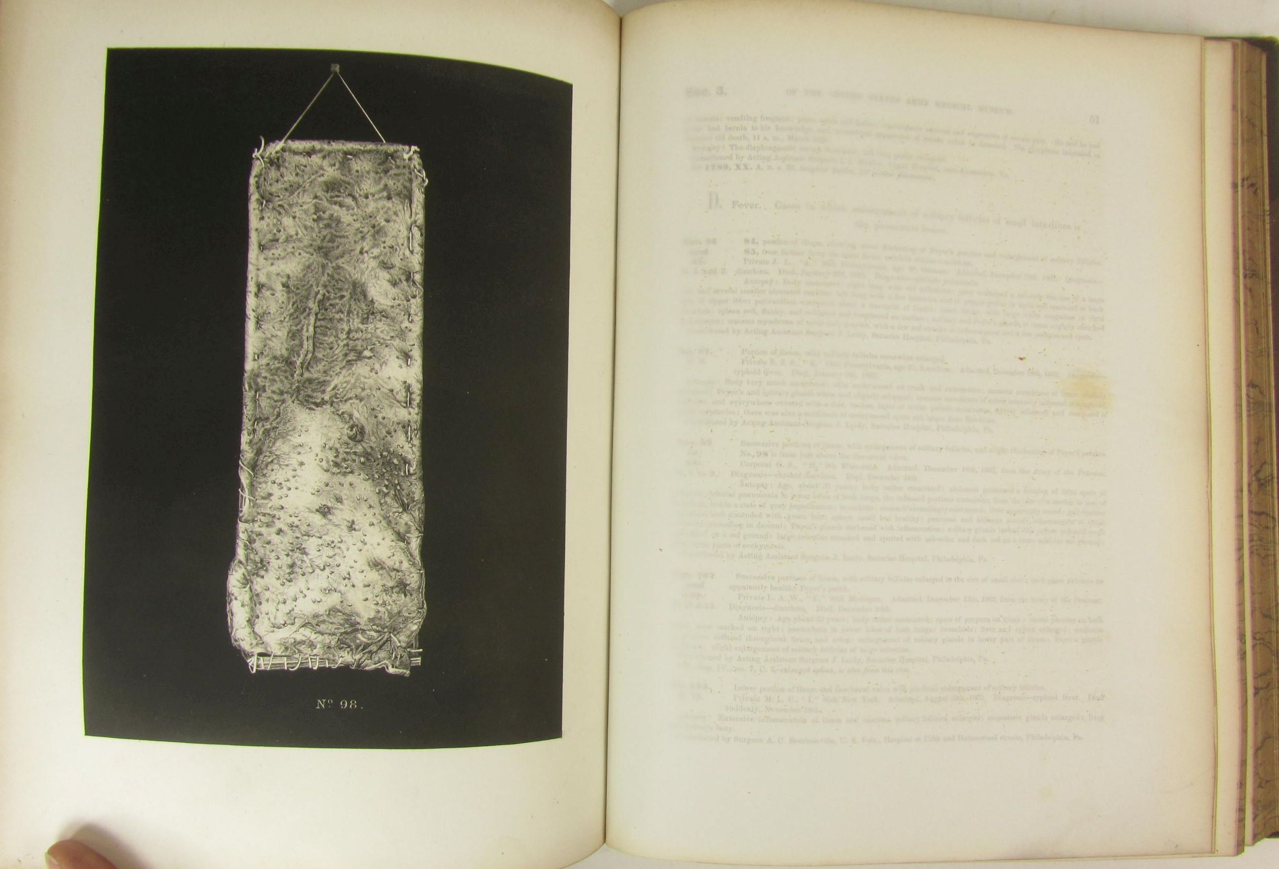 Medicine - Civil War Surgery - United States Army Medical Museum